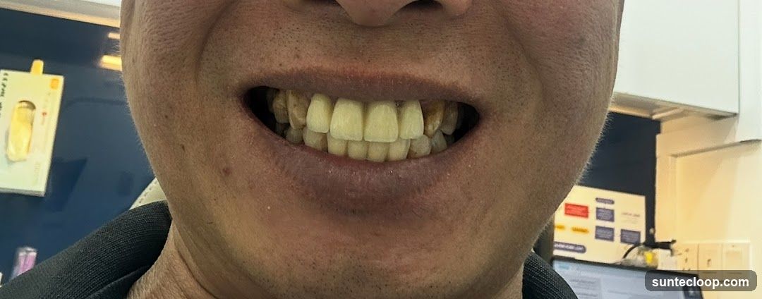 Close-up of a person's mouth with dental work