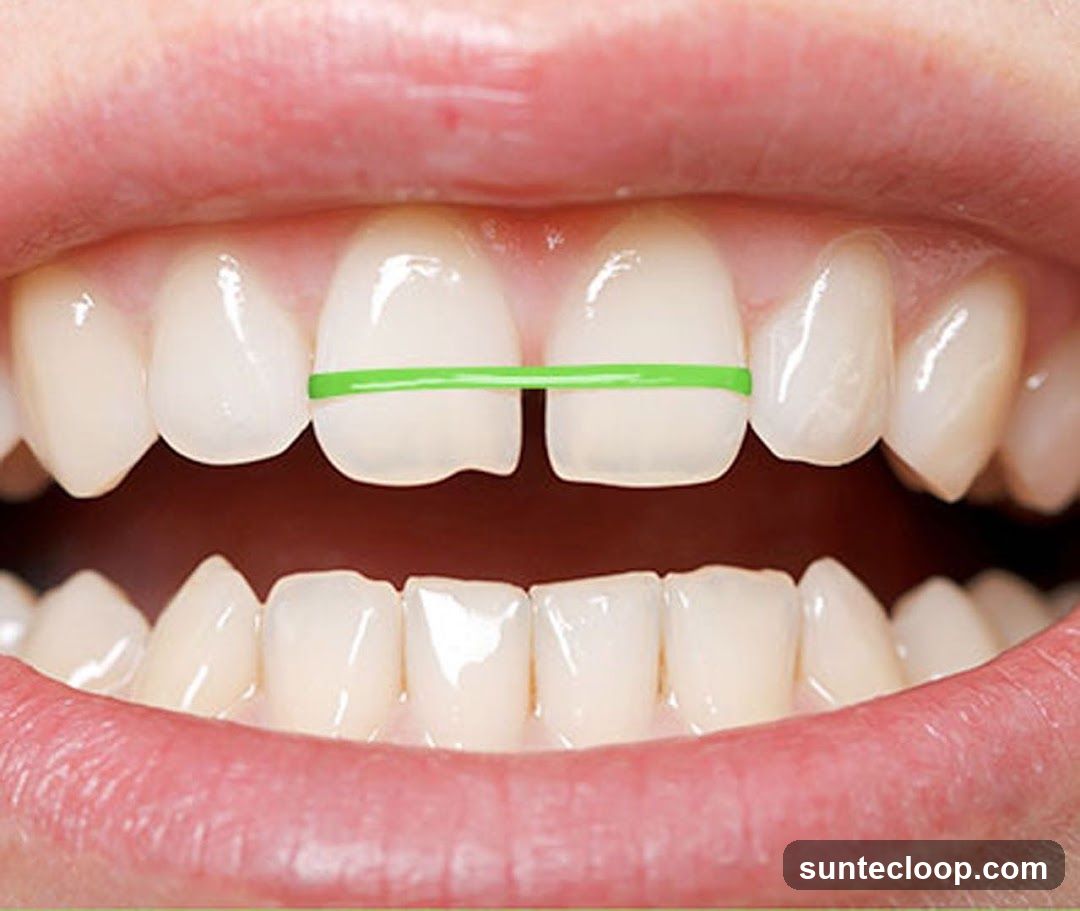 Dental Elastics